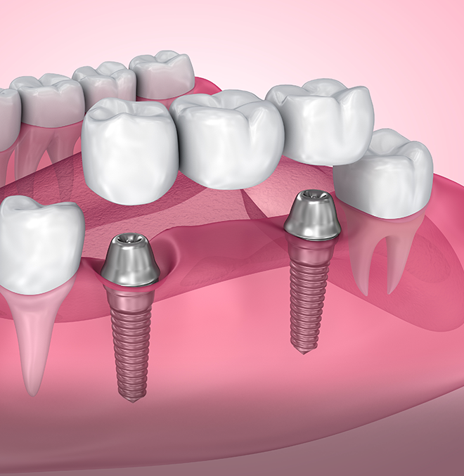 bridgesimg Treatment - Forest Dental