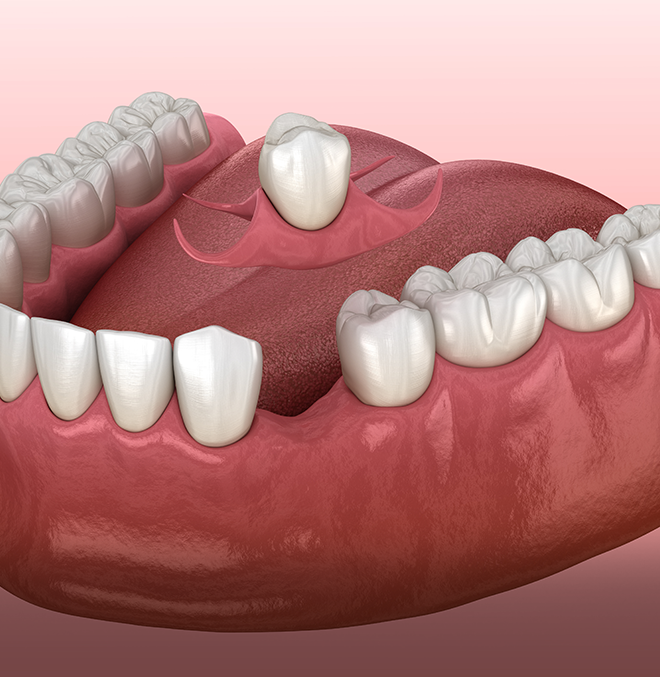 crownimg Treatment - Forest Dental